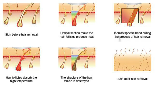 SHR Hair Removal Working Theory