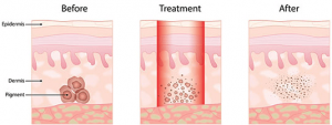 Pigmented Lesion IPL or Laser Treatment - Skin Hyperpigmentation