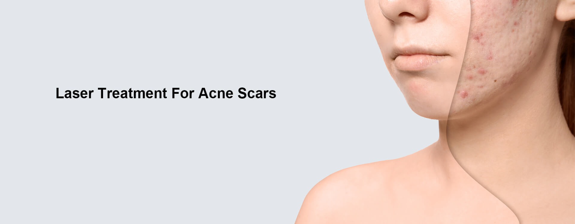 Laser Treatment For Acne Scars In Qatar