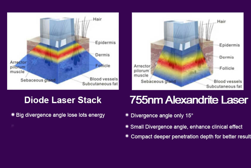 755nm Alexandrite Laser Technology