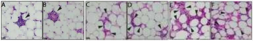 (30 days after treatment) sections showing 100X magnification: A and B show lobular inflammation within the fat lobule with properties lymphocytes and neutrophils, C and D show areas of inflammation and degenerated adipocyte membranes, E and F show degeneration Adipocytes, adipocytes, and neutrophils and lymphocytes associated with fat necrosis.