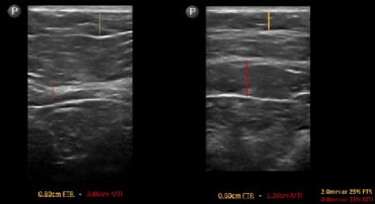 The red line shows a 33% increase in muscle mass. The yellow line shows a 25% decrease in fat thickness.