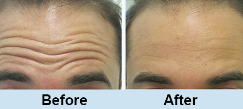 Forehead wrinkle removal